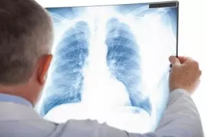 Analize pokazale velike sposobnosti kancera pluća