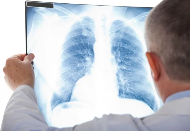 Za 2 mjeseca 10 žrtava: Opasna zaraza puni bolnice u RS-u, ova 2 simptoma ni slučajno ne ignorišite