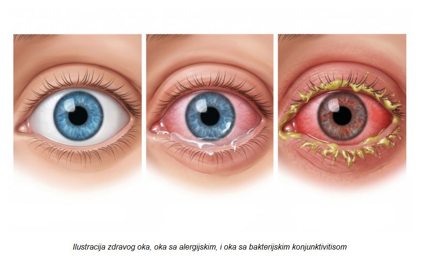 Alergijski konjunktivitis: simptomi, prevencija i lečenje alergija oka